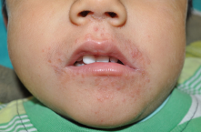 Dermatitis perioral